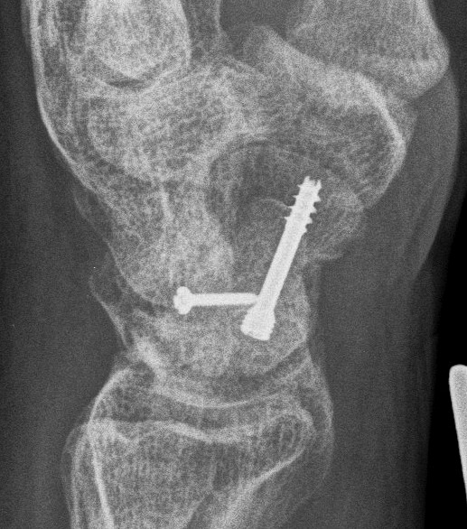 Scaphoid Proximal Pole Nonunion Bone Graft 2